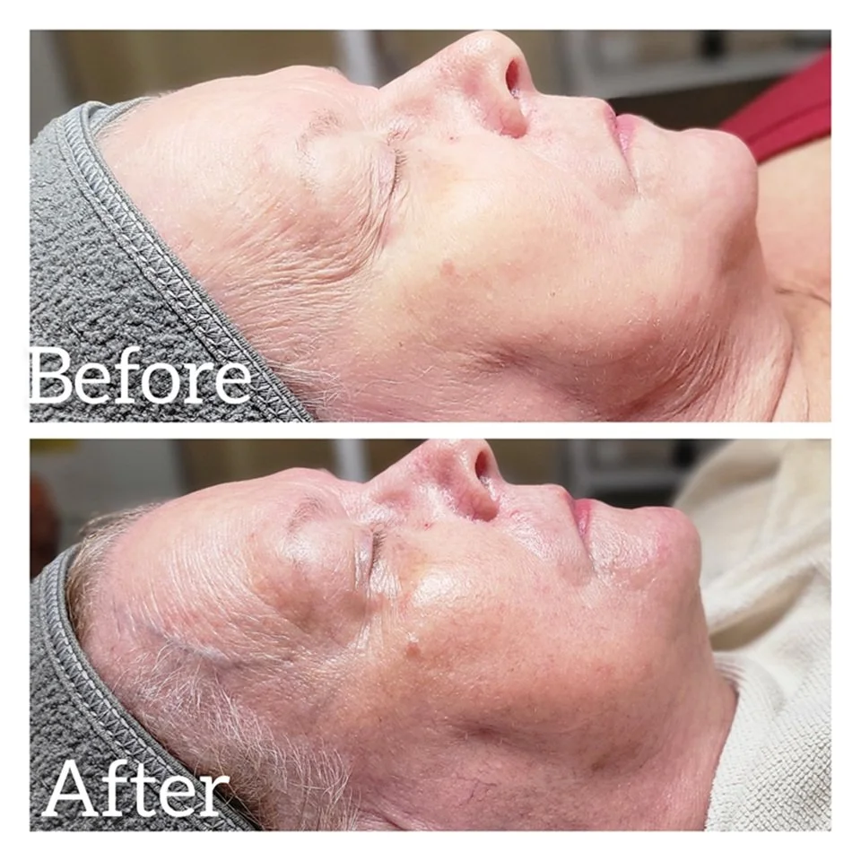 Microneedling