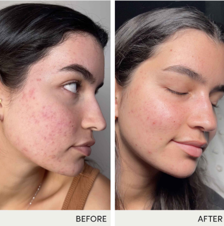 jane iredale, jane iredale supplement, supplements, clean, beauty, clean supplements, acne, acne help, acne supplement