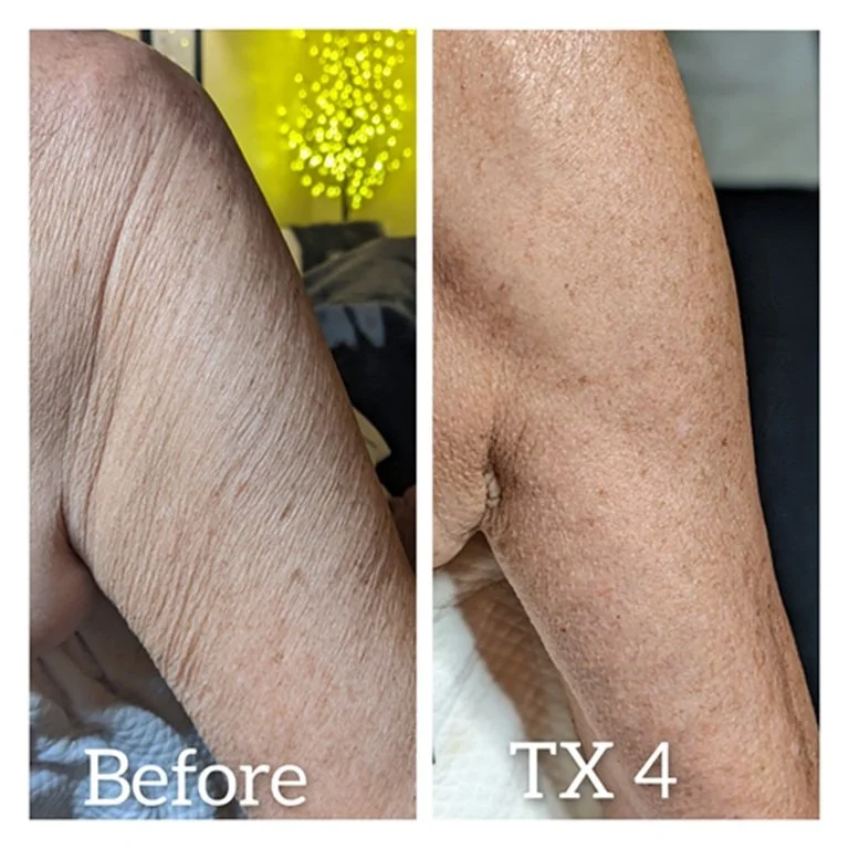 Firming Arm Treatment