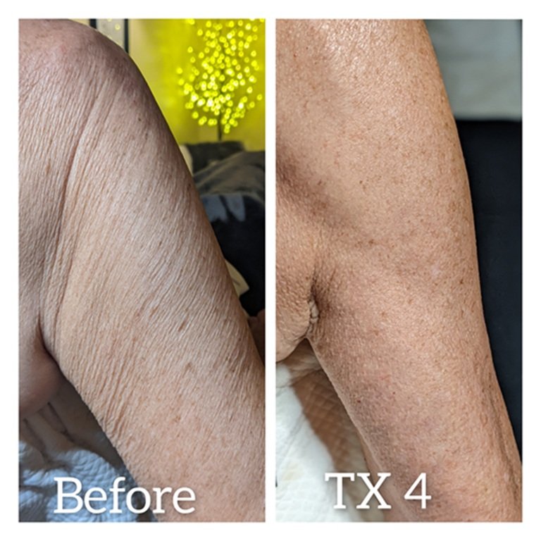 firming arm, firming arm treatment, tighten, firm, anti aging