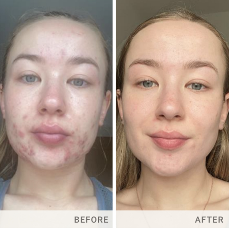 jane iredale, jane iredale supplement, supplements, clean, beauty, clean supplements, acne, acne help, acne supplement
