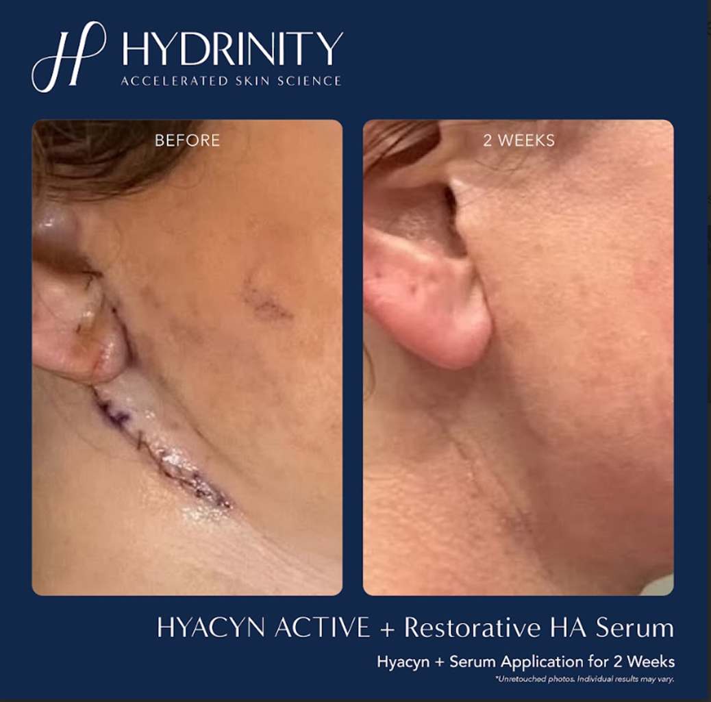 hydrintiy BA restore serum + mist scar.png