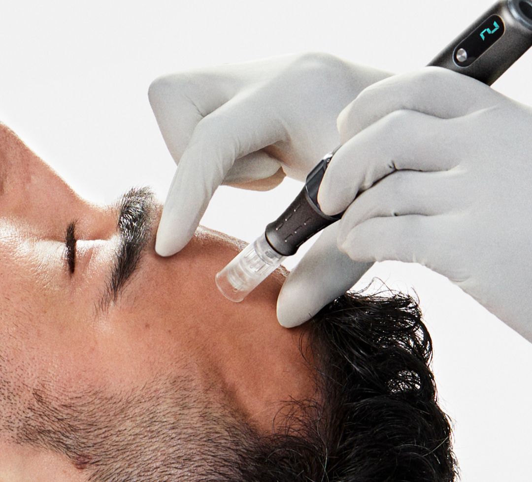 microneedling near me, microneedling for acne scars, fine lines, wrinkles, uneven skin