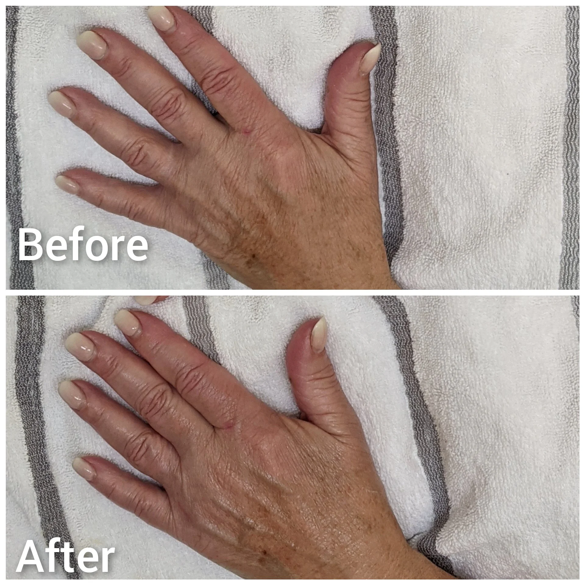 Hand Treatment