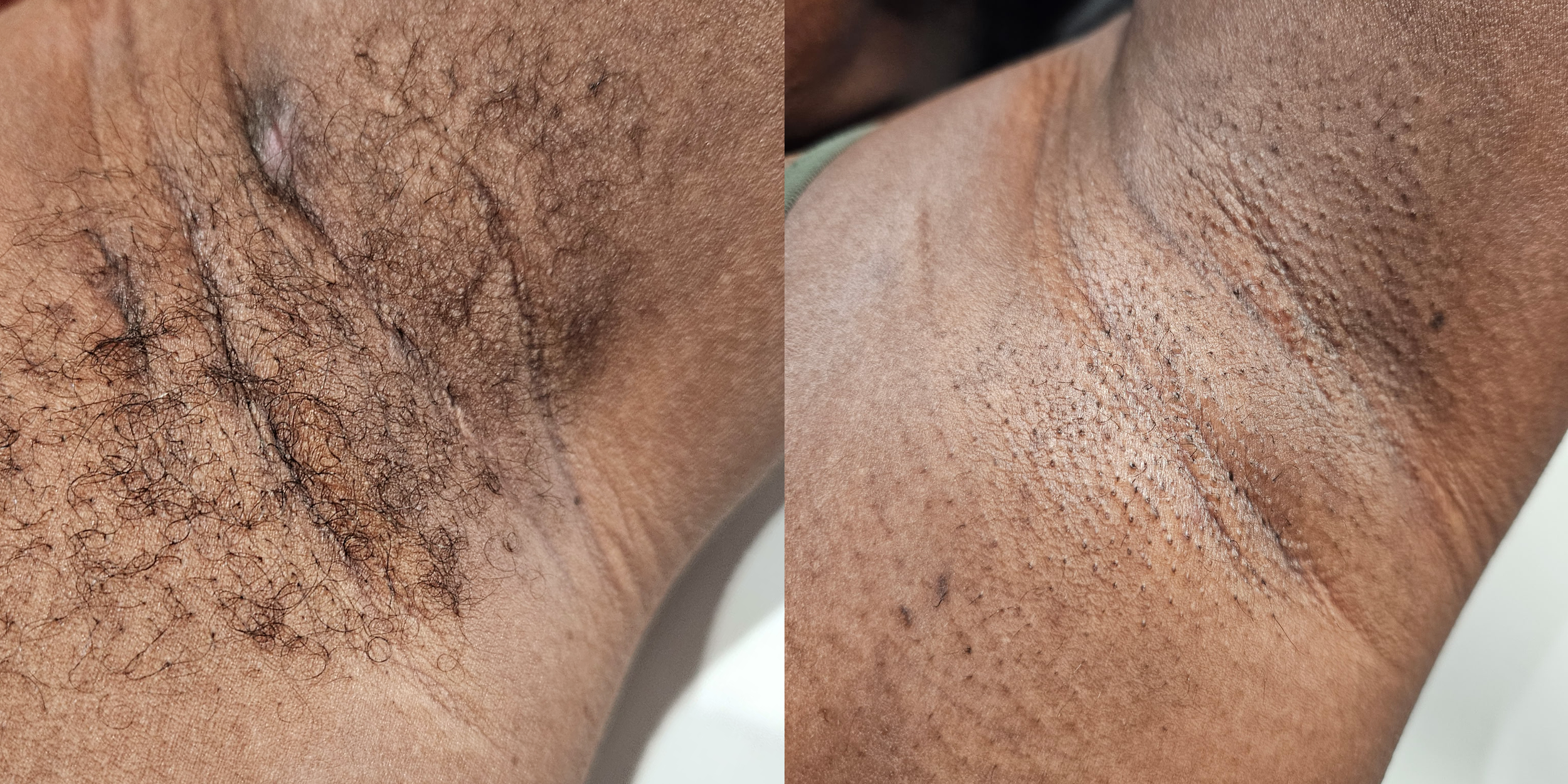 Close-up of a person's armpit with dark hair and smooth skin.