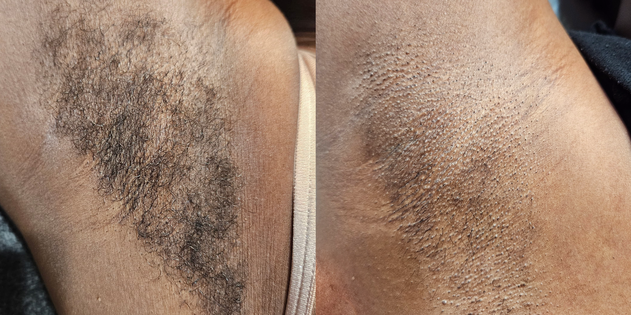 Close-up of a person's armpit showing a before and after comparison of hair removal, with the left side having dense, curly hair and the right side showing smooth, shaved skin.