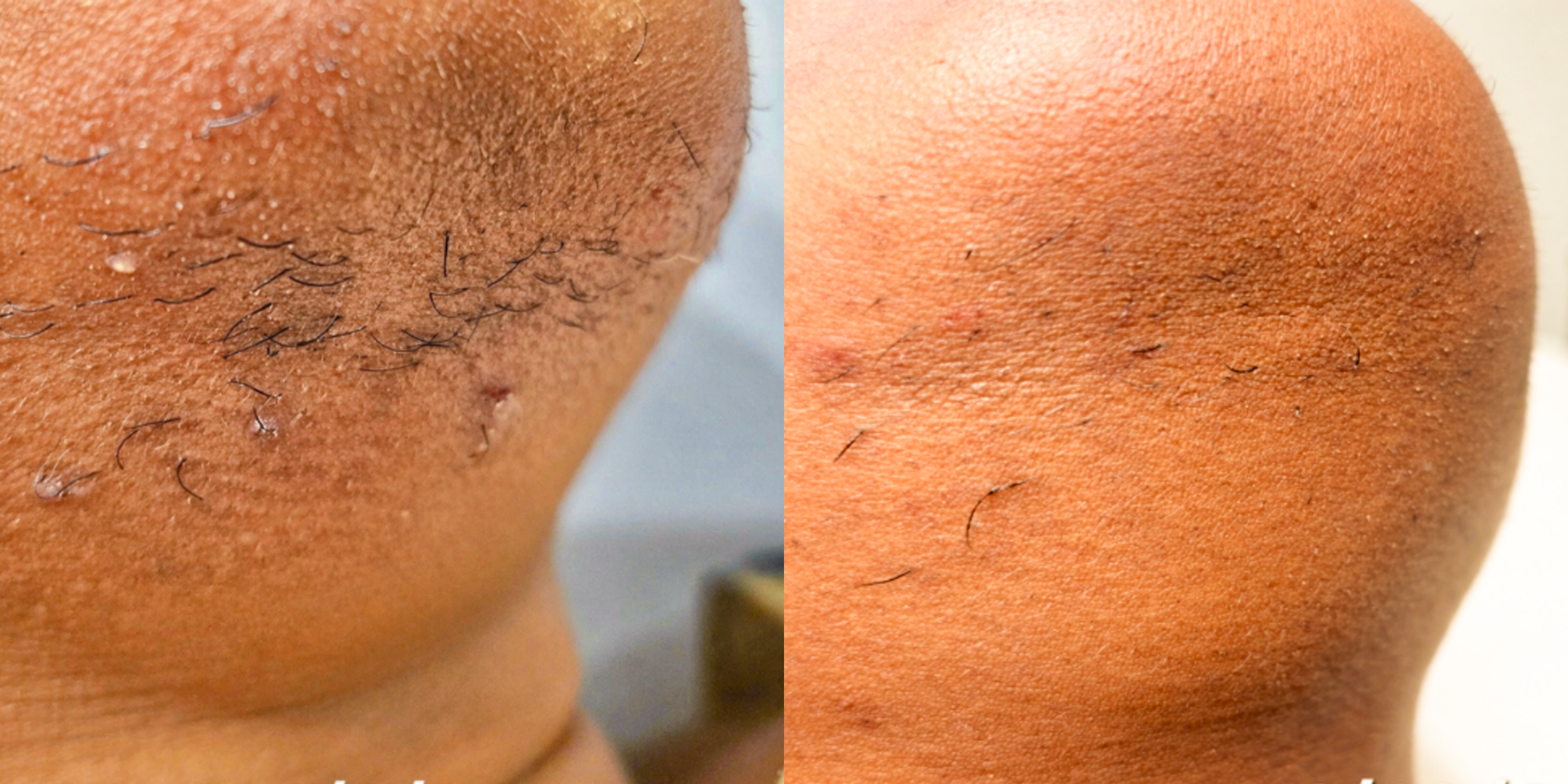 Comparison of close-up skin with and without hair removal, showing smoother skin on the right side.