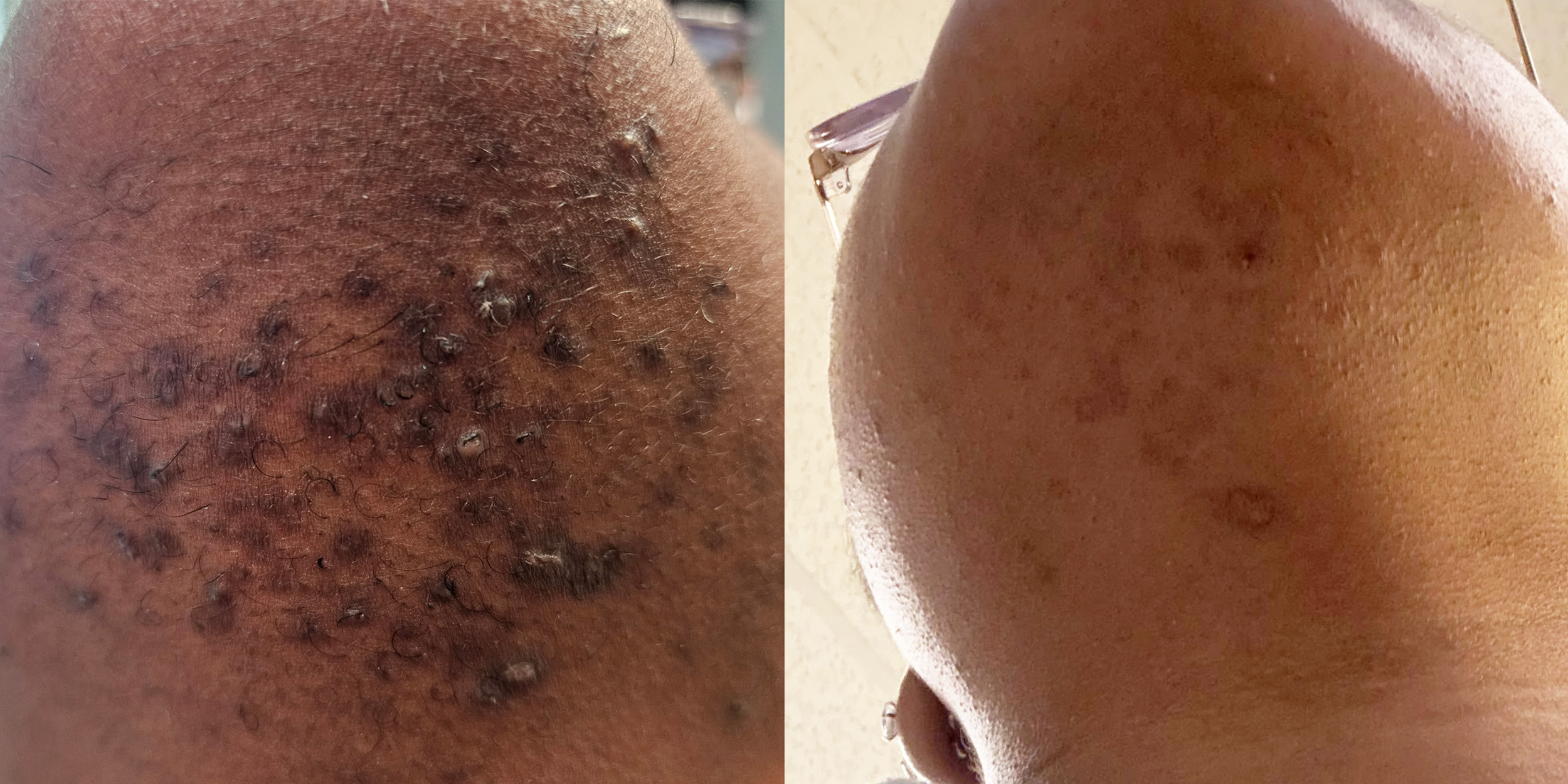 A side-by-side comparison of a person's skin before and after hair removal. The left side shows skin with dark hair follicles and hair growth, while the right side shows smooth, hair-free skin.