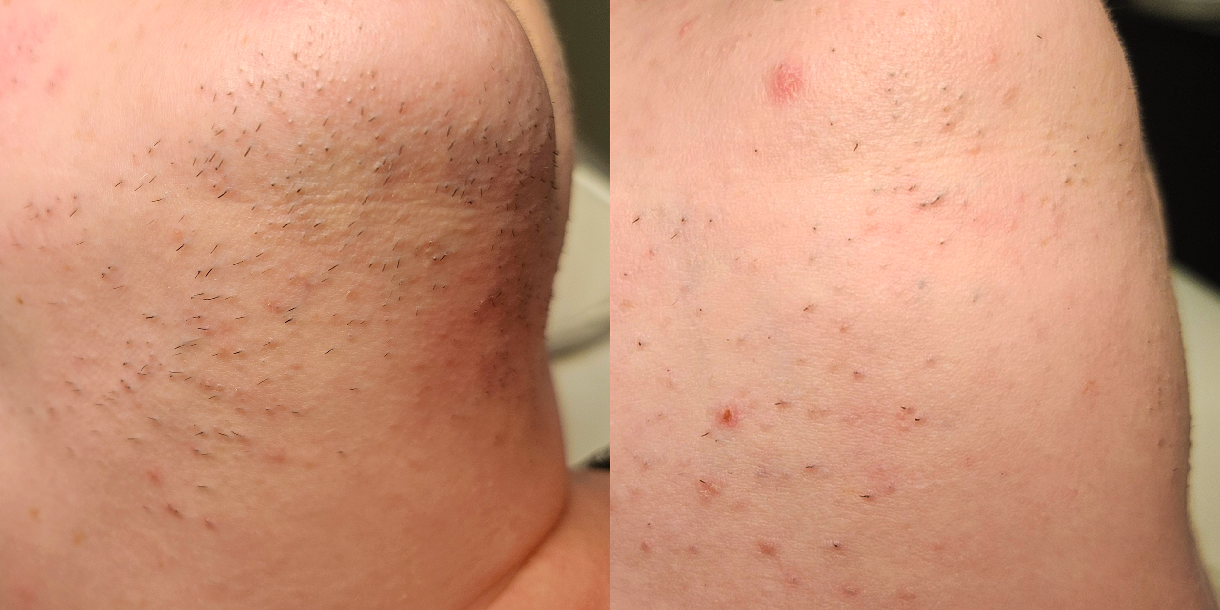Comparison of a person's skin before and after hair removal; the left side shows skin with hair follicles and stubble, the right side shows smooth, hair-free skin with some small red spots.