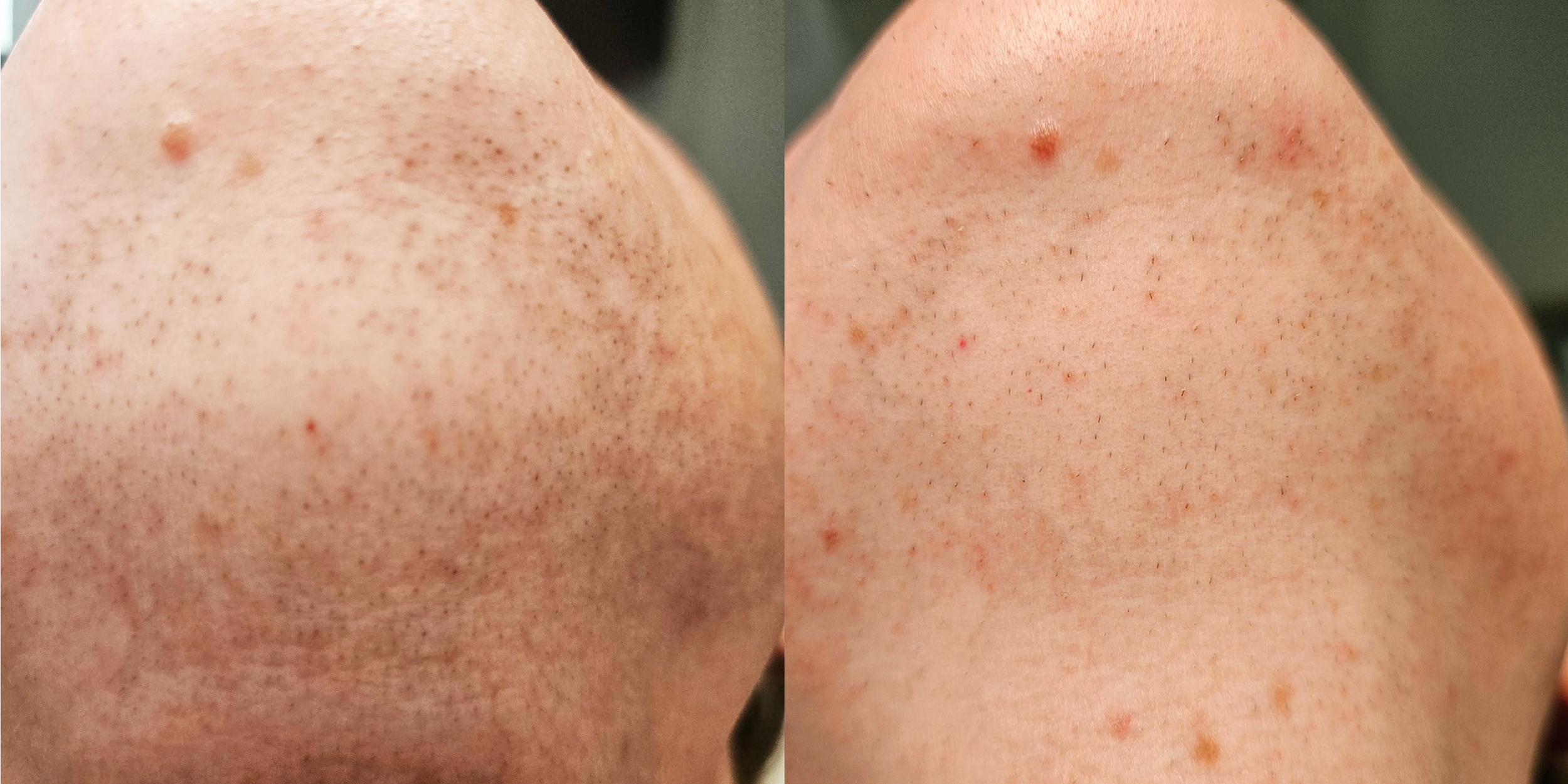Close-up of a person's chin with visible stubble, showing a comparison before and after a electrolysis treatment and improvement.