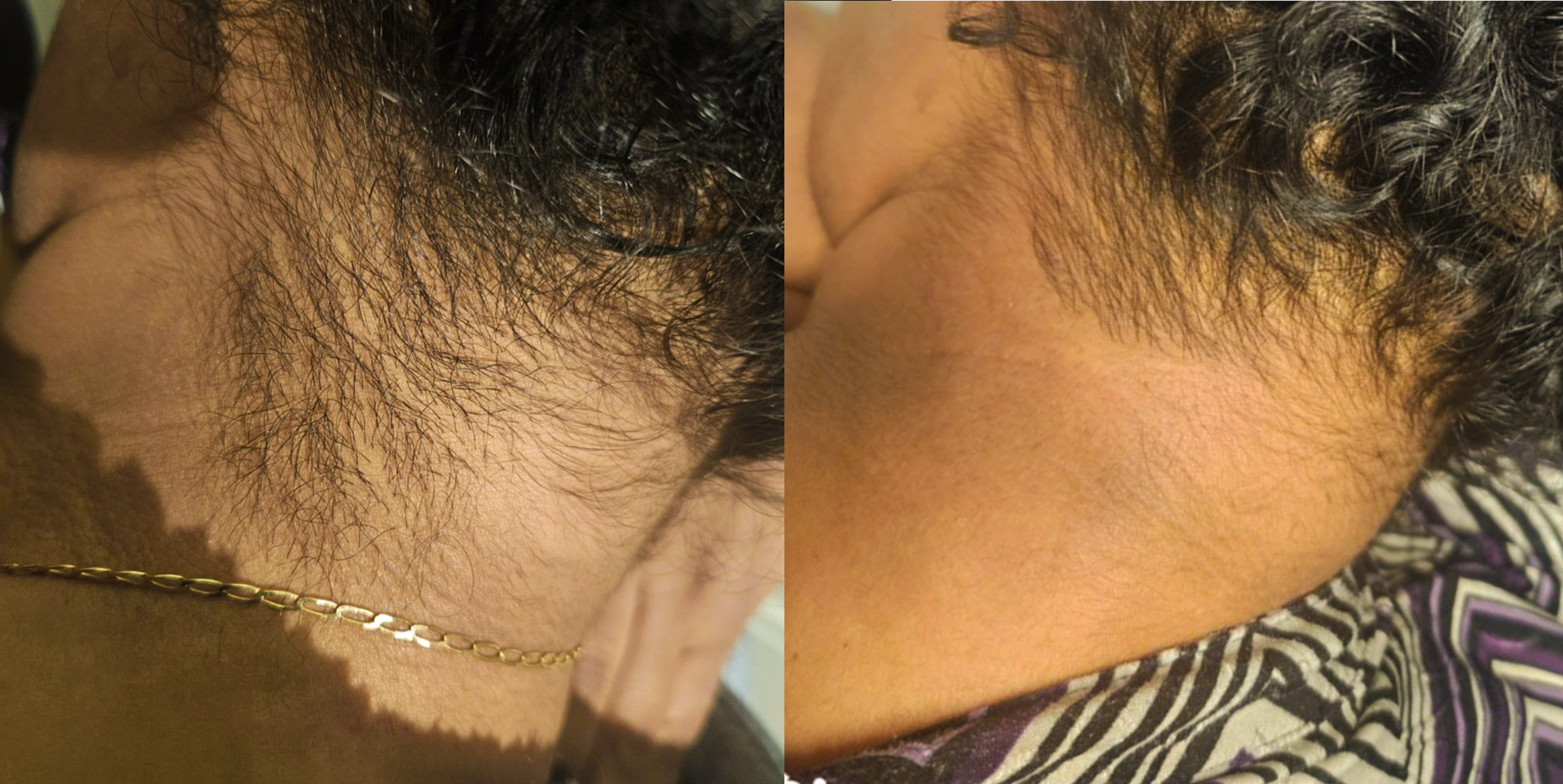 Side-by-side comparison of two images showing the same person's hairline, with the left showing a fuller, thicker hairline and the right showing a thinner, more refined hairline.