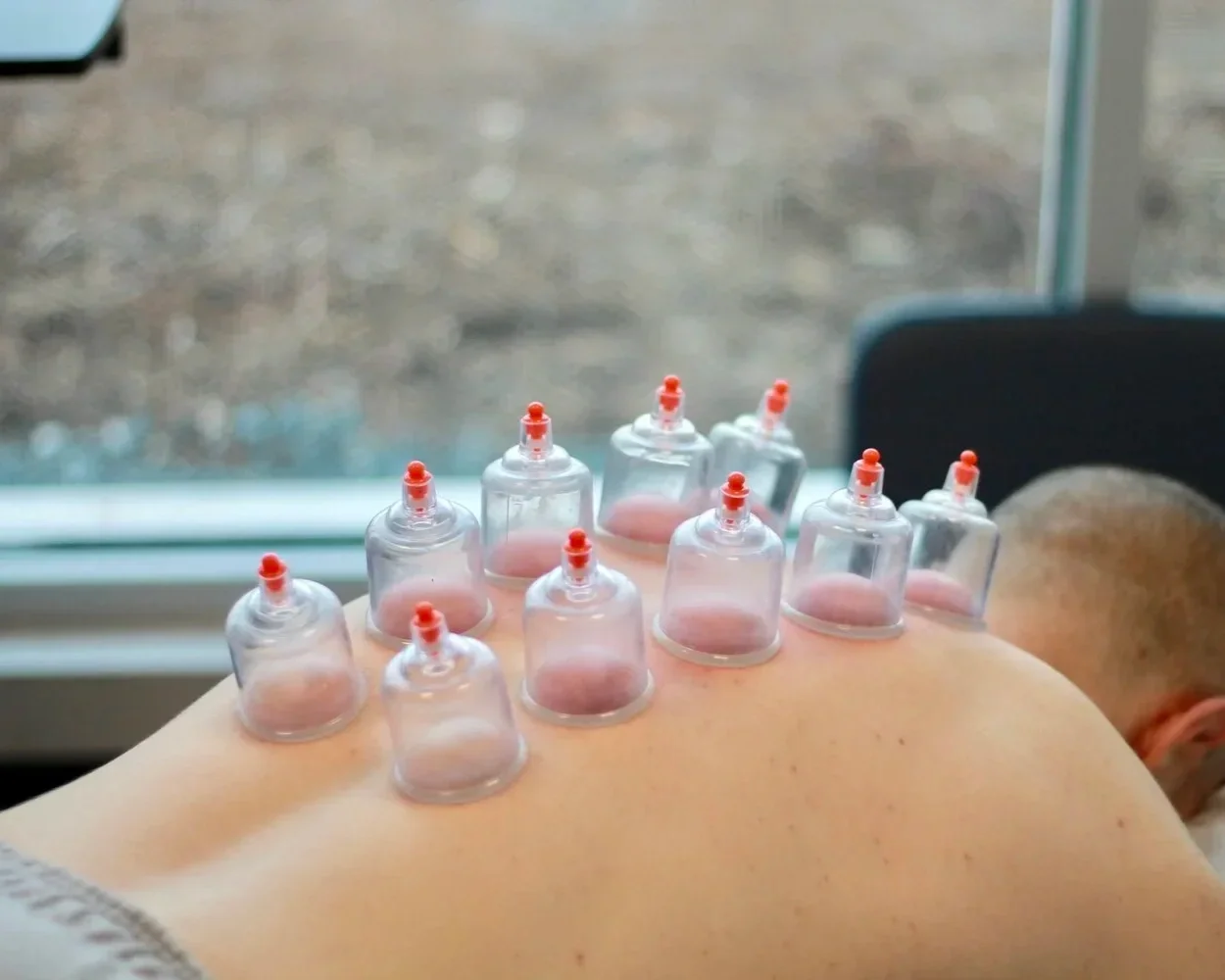 A person receiving cupping therapy with several small transparent cups placed on their back outside a window.