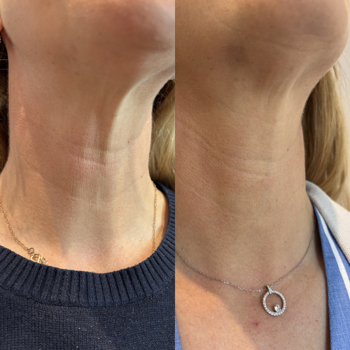 Close-up of a woman's neck and lower face, showing a comparison of two necklaces. The left side features a gold chain, and the right side has a silver chain with a circular pendant with small gemstones.