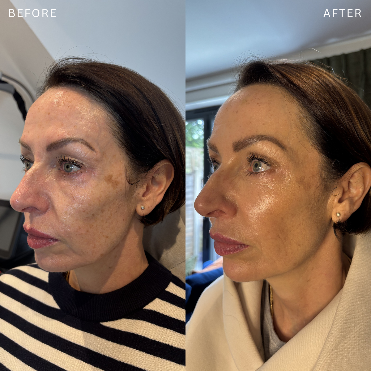 Side-by-side comparison of a woman's face before and after skincare or cosmetic treatment, showing significant reduction in dark spots and an improved skin texture.