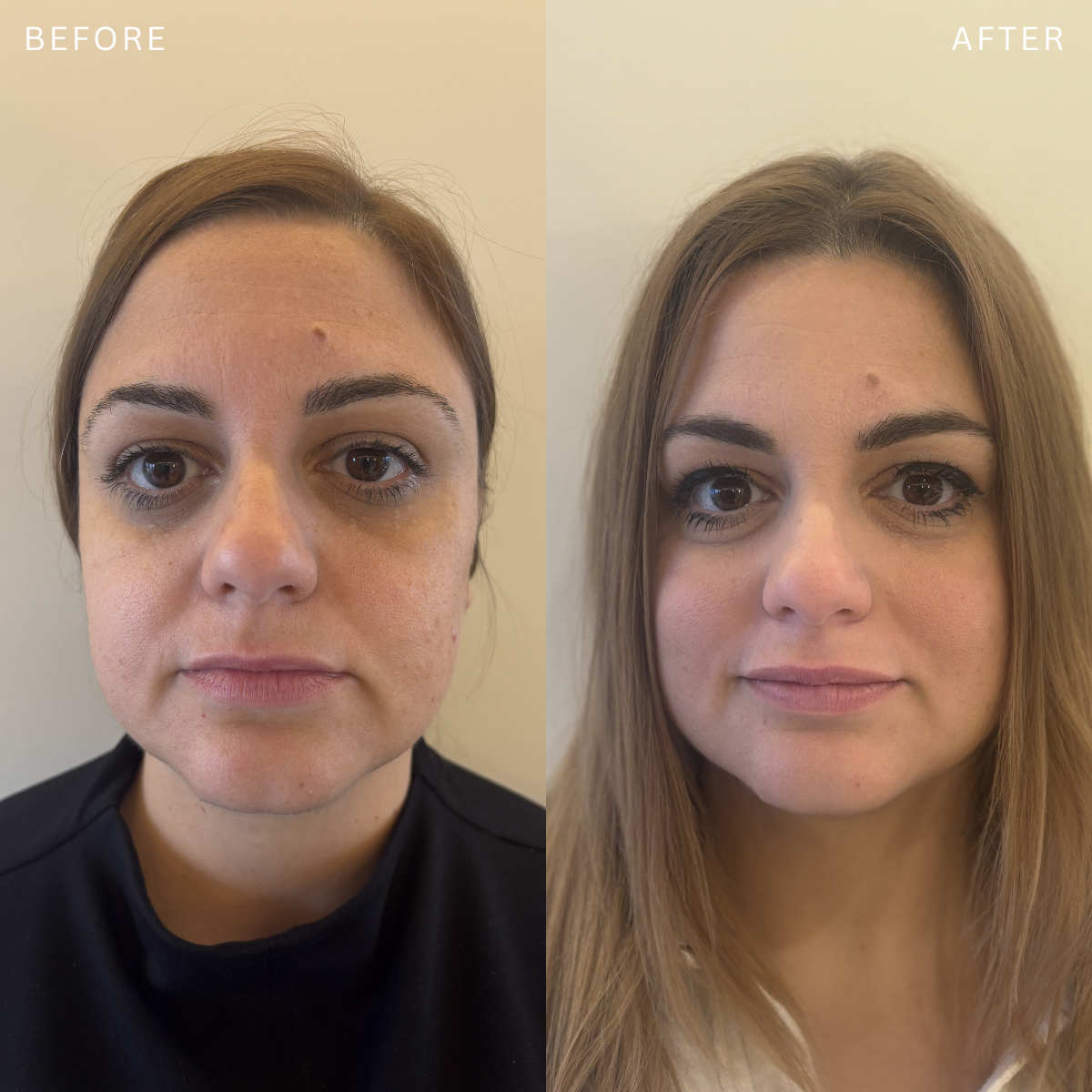 Side-by-side comparison of a woman before and after a skincare treatment, showing improvements in skin texture and tone.