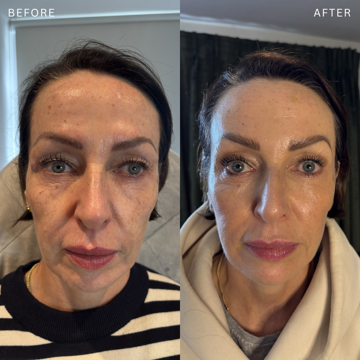 Side-by-side comparison of a woman before and after filler, showing improvements in skin texture and appearance.