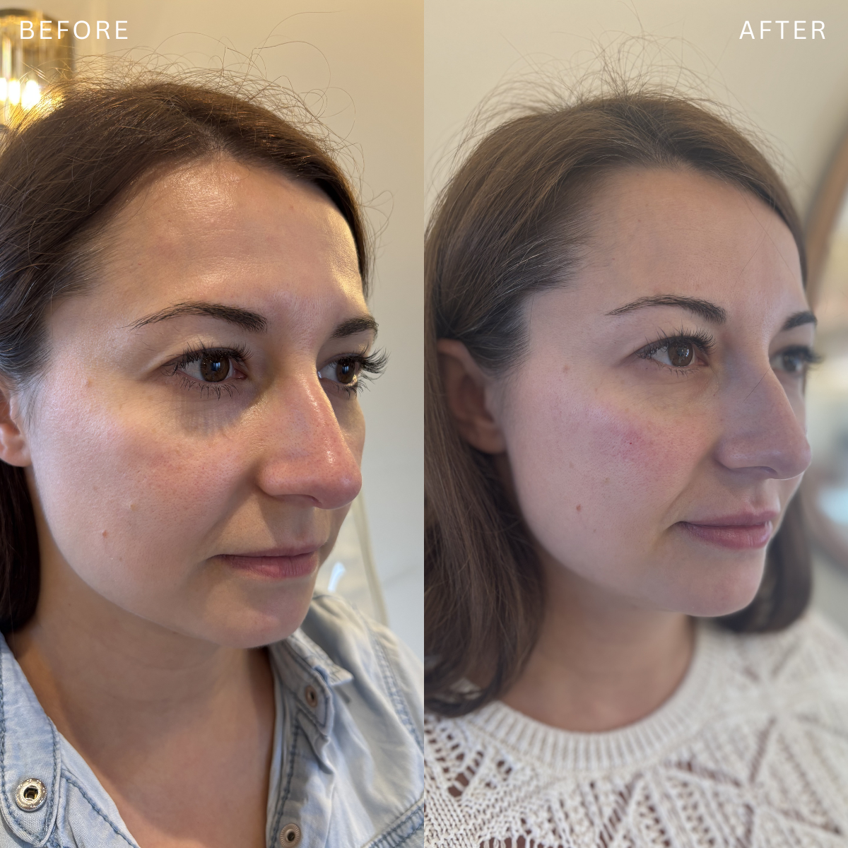 Before and after side-by-side photos of a woman showing her skin improvement after filler, with the left labeled 'before' and the right labeled 'after'.