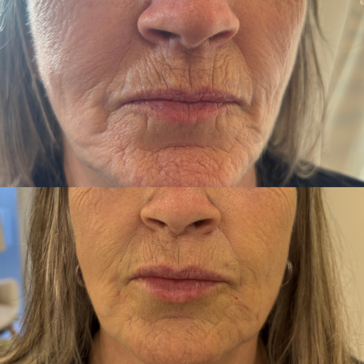 Close-up comparison of a woman's lower face showing significant skin aging signs in before and after images, including wrinkles and skin texture improvements.