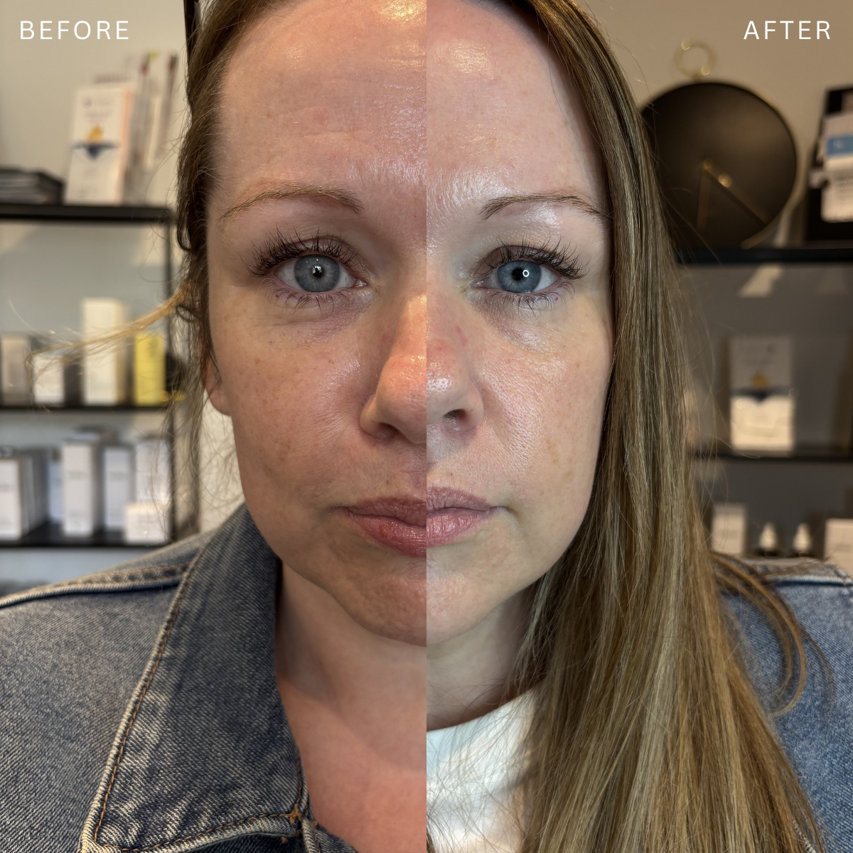 Split image showing before and after skincare, with a woman having clear, glowing skin on the right side after skincare treatment, and duller skin with blemishes on the left side before treatment.