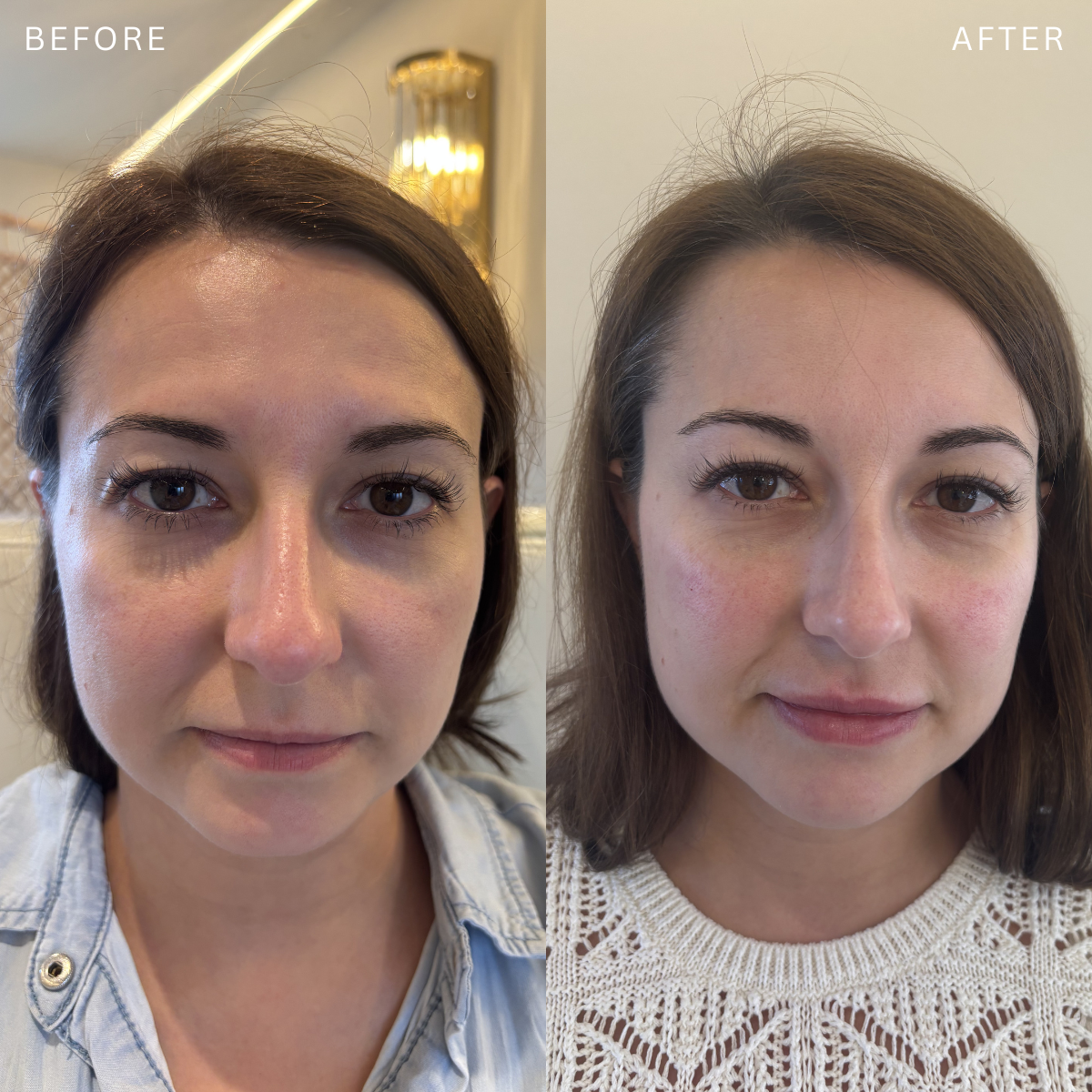 Side-by-side comparison of a woman's face before and after a skincare treatment. The left shows her with smoother skin, while the right shows her with some redness and slight skin texture changes.