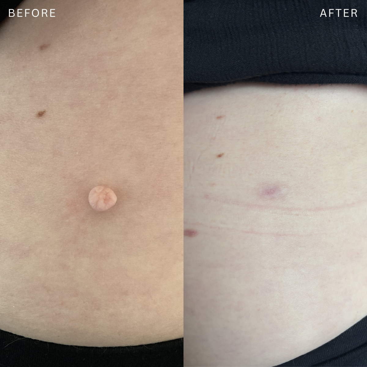Comparison of a person's belly before and after removal of a skin tag, showing a clear difference in skin appearance.
