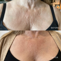 Comparison of skin on upper chest before and after treatment, showing improved skin appearance in the after image