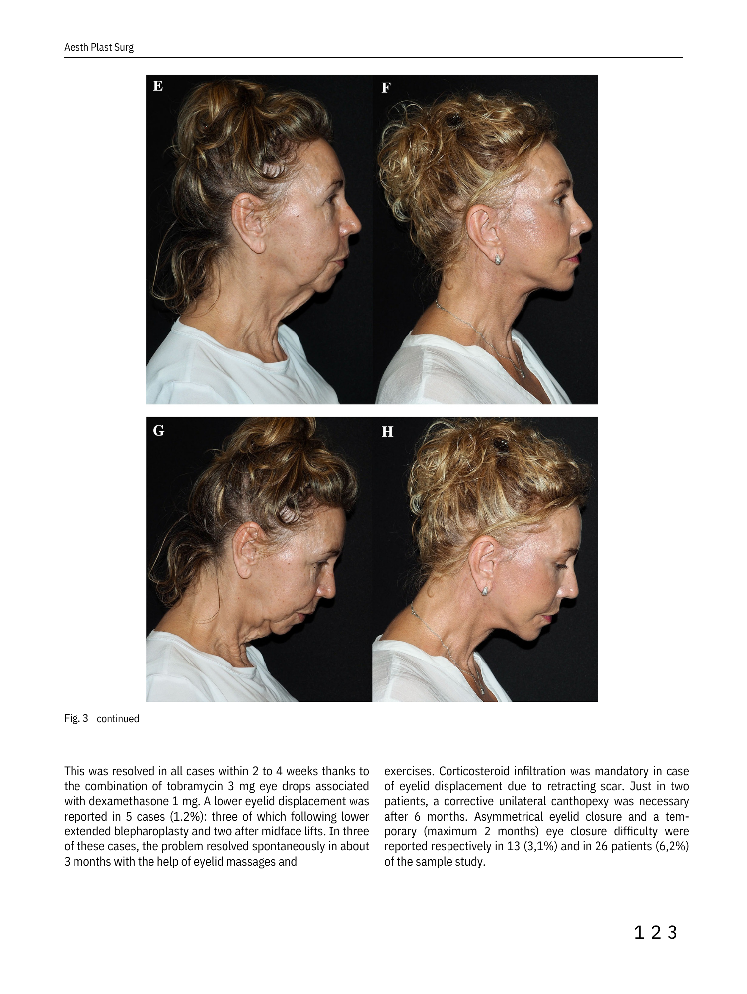 Immagini di due donne in profilo, prima e dopo un intervento estetico al volto. Prima con pelle cadente e segni di invecchiamento, dopo con pelle più tonica e ringiovanita.