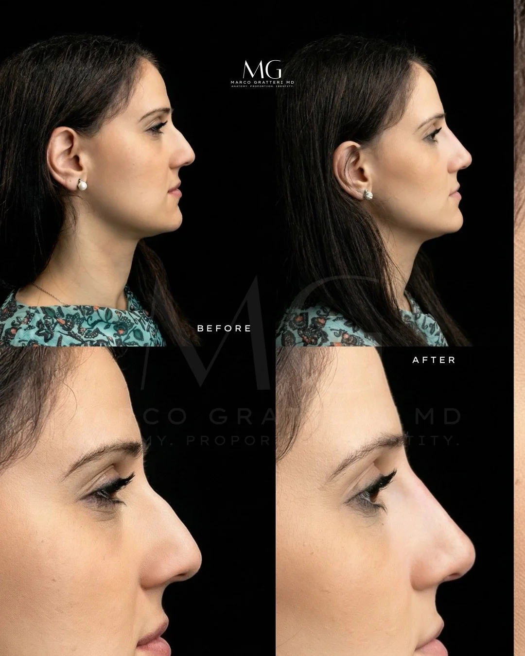 Non sempre per migliorare il profilo del naso &egrave; necessario ricorrere alla chirurgia.
In casi selezionati, il rinofiller consente di armonizzare il dorso, correggere piccole irregolarit&agrave; e rendere il profilo pi&ugrave; equilibrato in mod