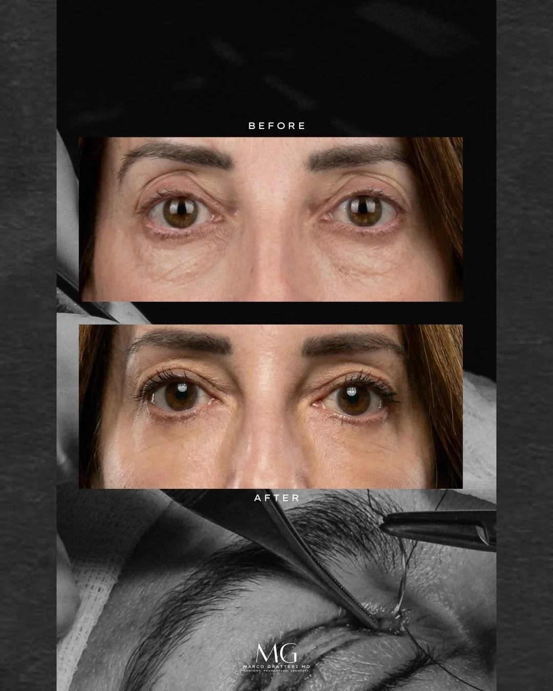 La blefaroplastica inferiore &egrave; percepita spesso come un intervento semplice. In realt&agrave; &egrave; un lavoro di precisione: scelta dei piani, rispetto dei tessuti, controllo dei dettagli che determinano un recupero corretto e un risultato 