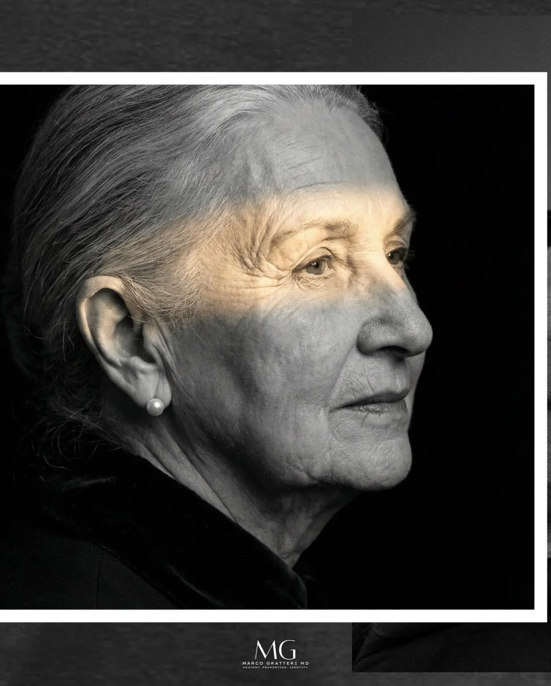 La regione temporale &egrave; una delle aree pi&ugrave; sottovalutate del volto, eppure &egrave; una di quelle che cambiano di pi&ugrave; la
percezione complessiva: quando la tempia si svuota, il volto appare pi&ugrave; &ldquo;stanco&rdquo;, pi&ugrav