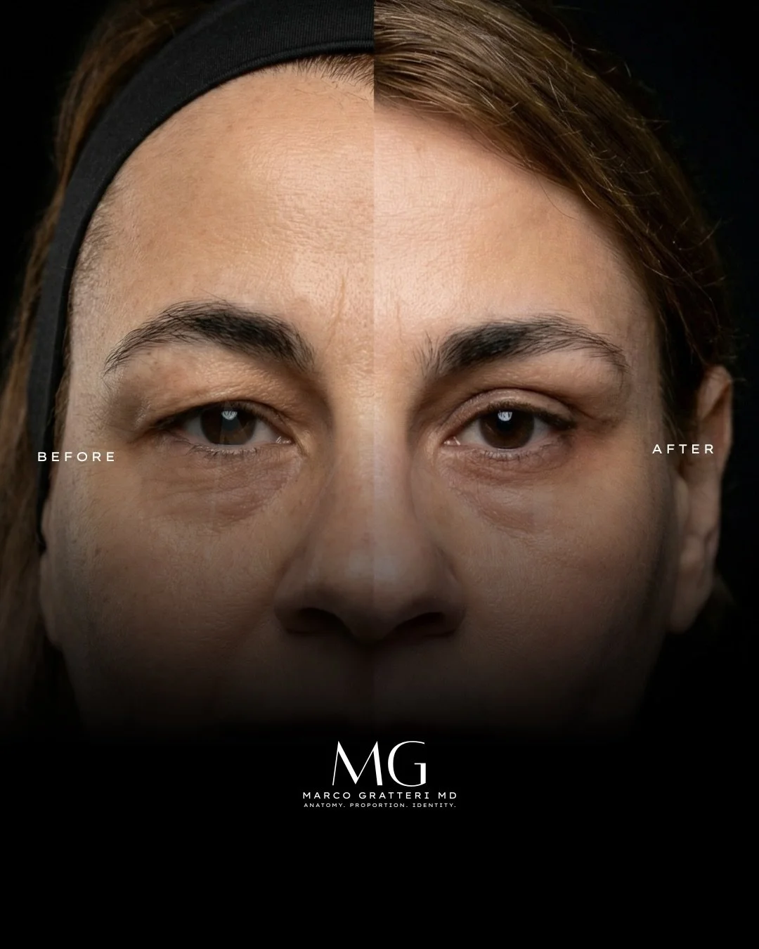 La blefaroplastica superiore non cambia uno sguardo: ne rimuove ci&ograve; che lo appesantisce.
In questo caso, l&rsquo;intervento ha permesso di alleggerire la palpebra superiore, restituendo maggiore apertura, definizione e armonia alla regione per