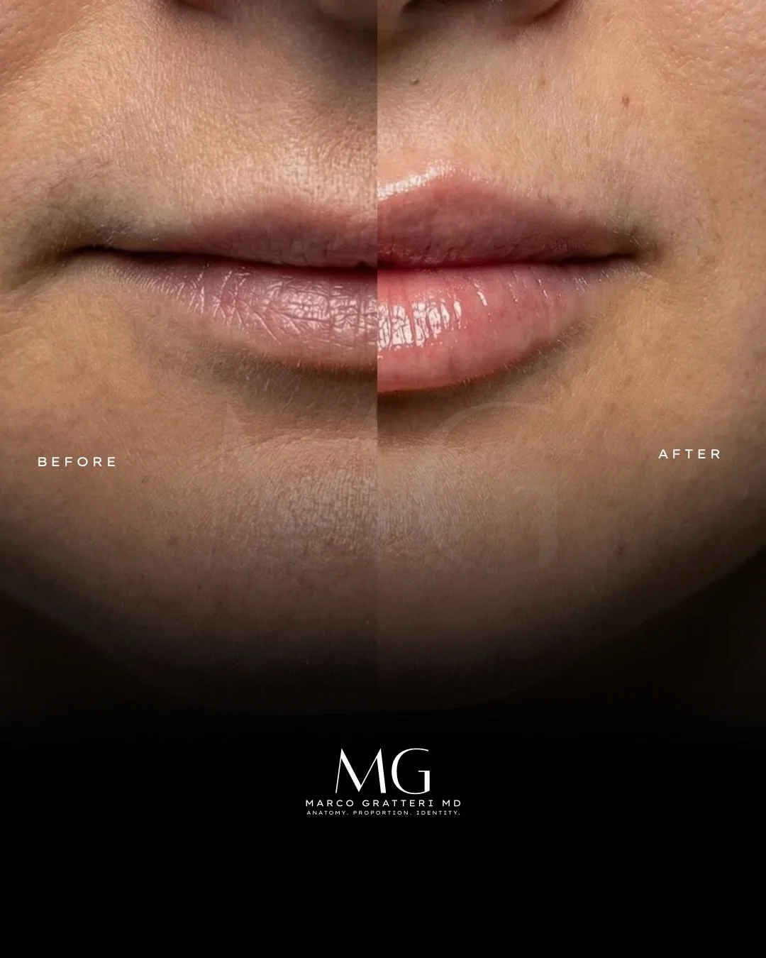 L&rsquo;armonizzazione delle labbra non riguarda il volume.
Riguarda proporzione, supporto e definizione.
Ogni intervento deve rispettare l&rsquo;anatomia del paziente:
forma del labbro, rapporto tra superiore e inferiore, dinamica del sorriso.
In qu