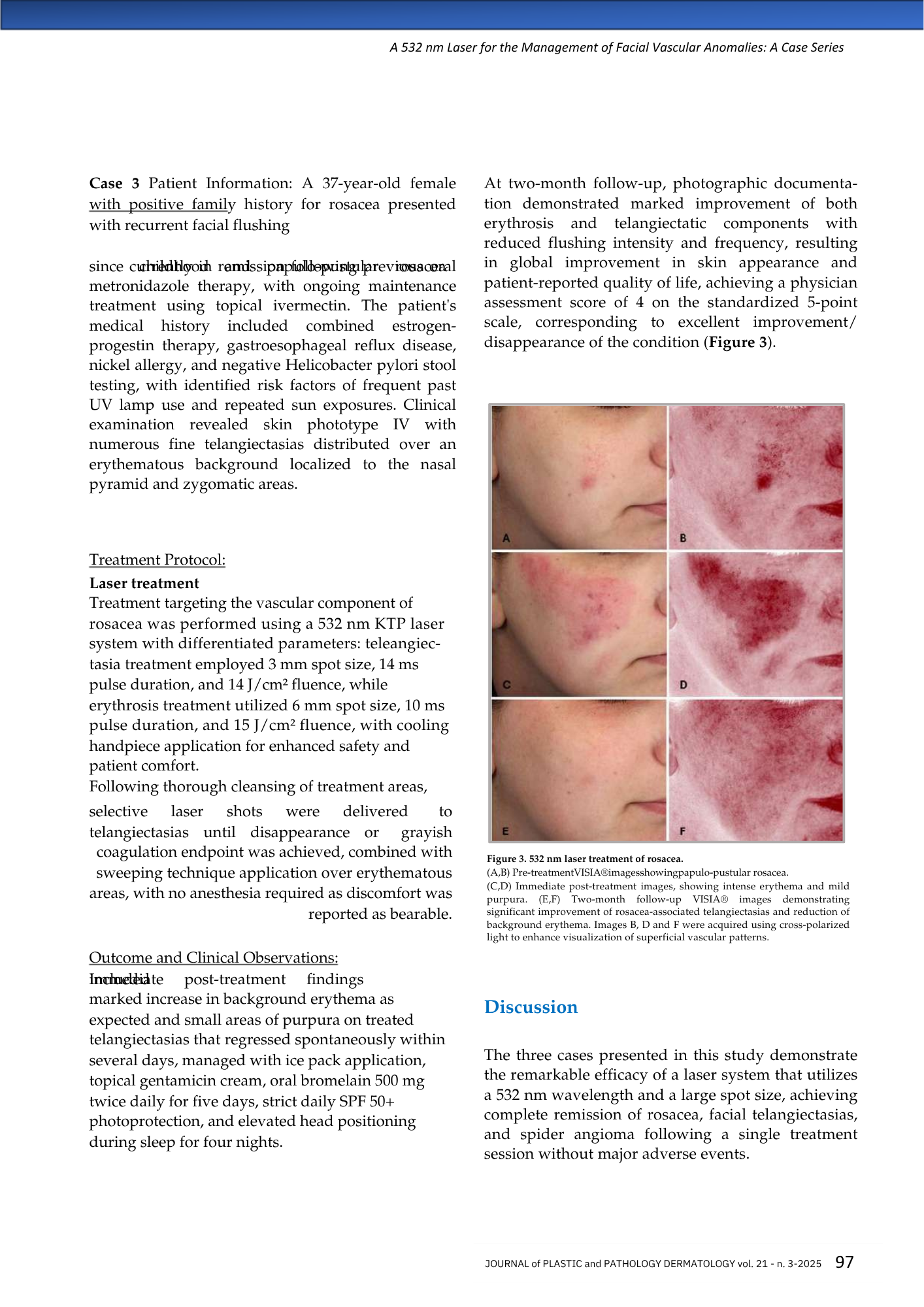 Pagina di articolo medico sul trattamento laser per rosacea con immagini pre e post trattamento, mostrando miglioramenti della pelle e riduzione dell'eritema.
