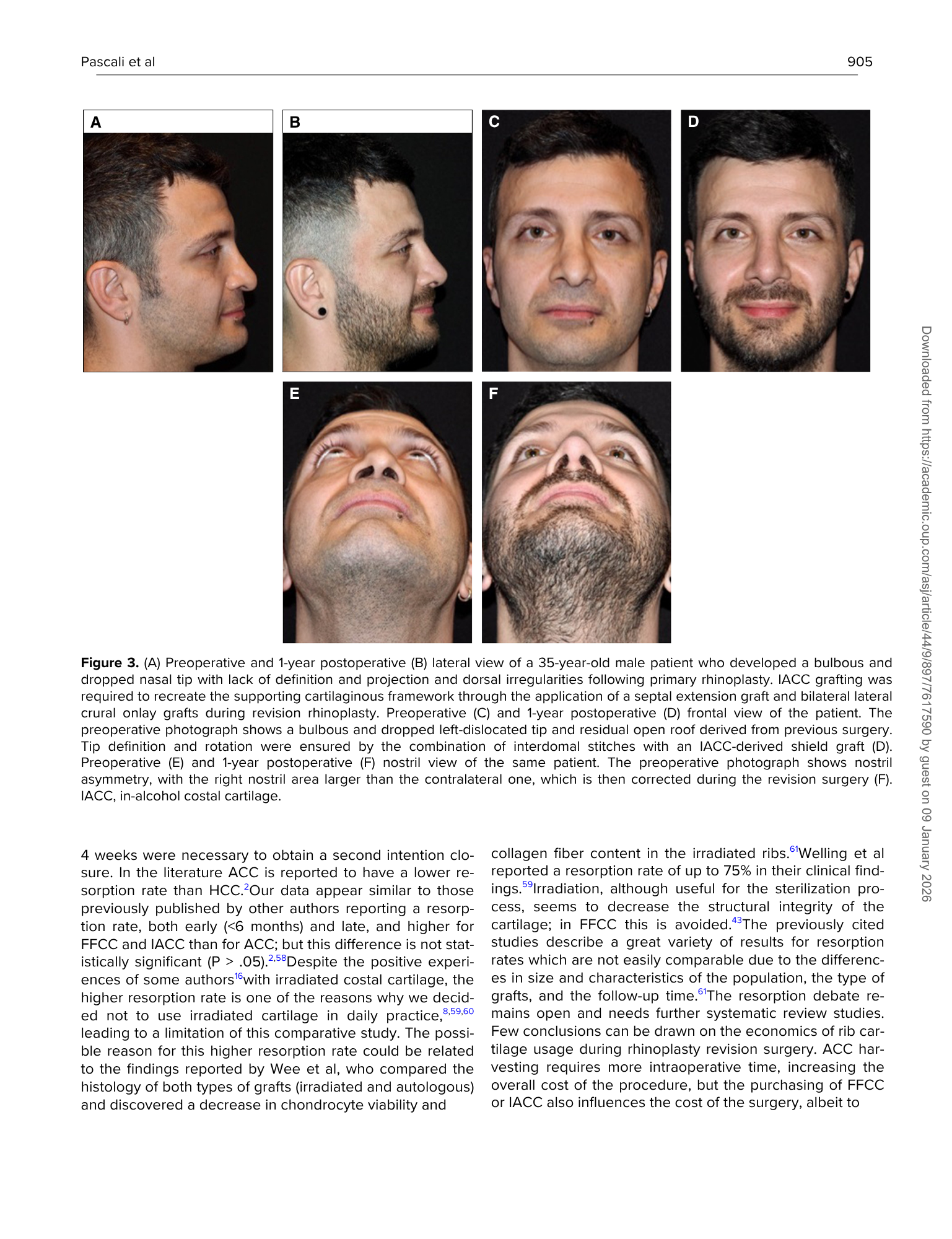 Fotografie di un uomo che mostra i risultati di un intervento di rinoplastica, con immagini frontali e laterali pre e post-operatorie che evidenziano le differenze nel profilo e nella forma del naso.
