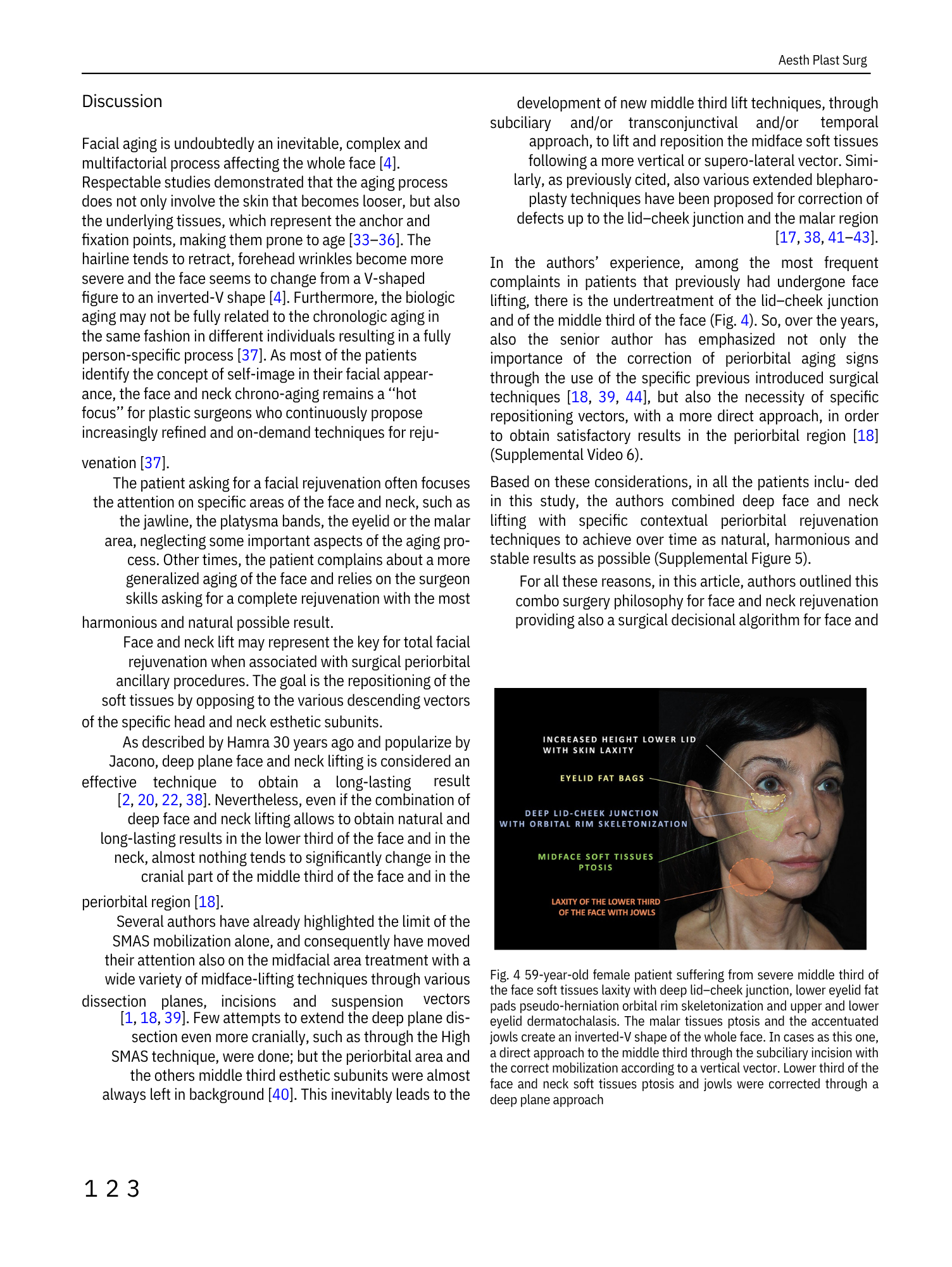 Diagramma di una paziente di 59 anni con età avanzata che mostra le aree di lassità dei tessuti molli del viso e del collo, evidenziate con etichette colorate che indicano diverse zone di trattamento e miglioramento estetico.