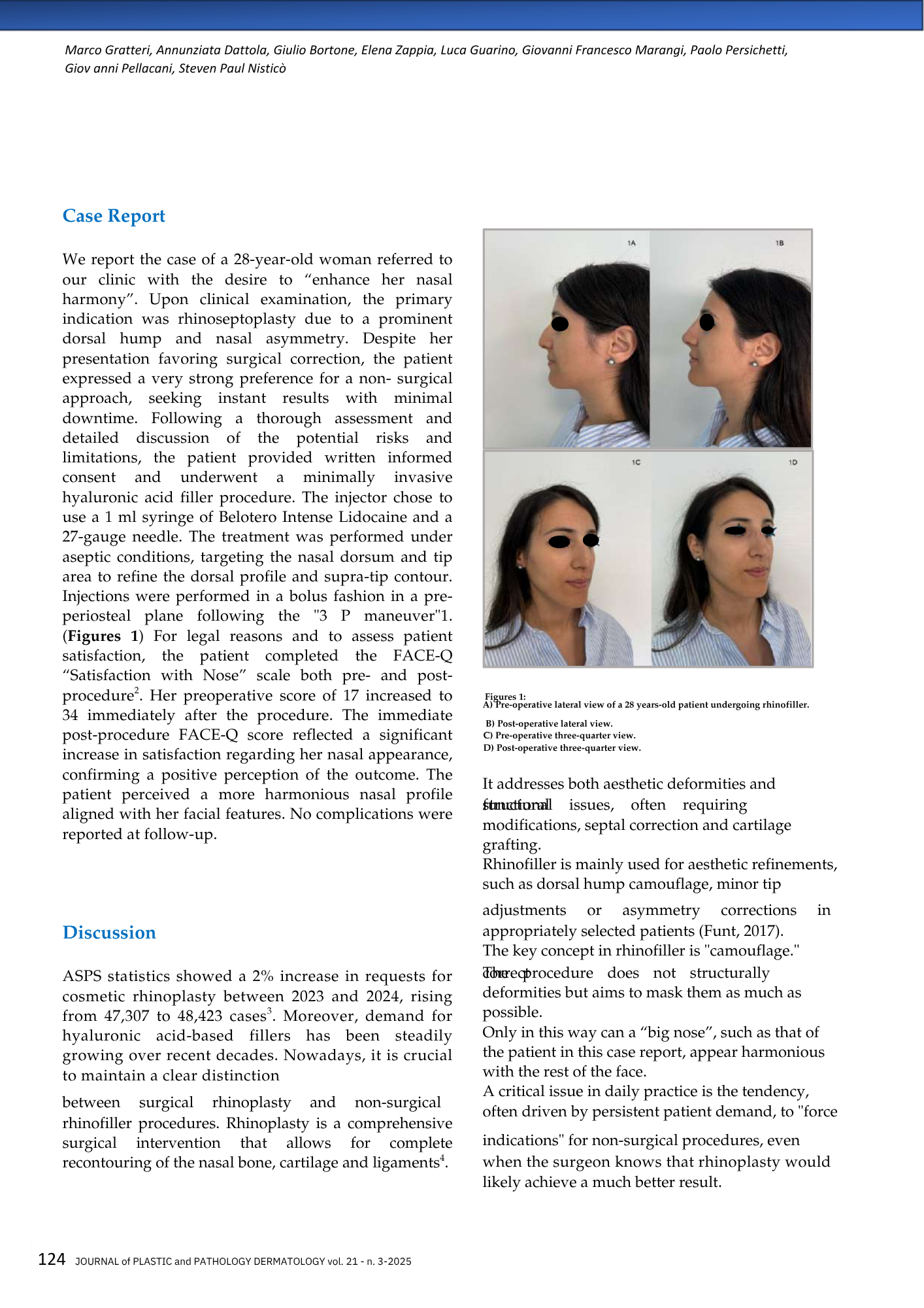 Documentazione medica con immagini pre e post intervento di rinofiller su donna, viste laterali del viso.