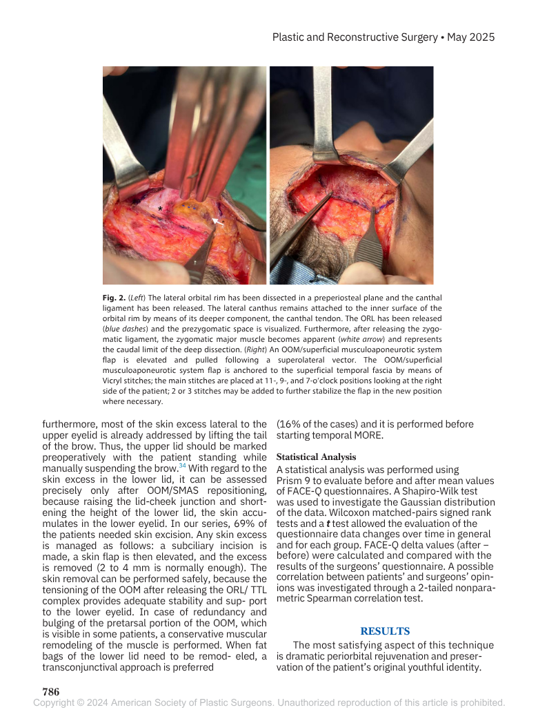 Immagine di due foto che mostrano un intervento chirurgico sulla zona orbitale, con utensili chirurgici e tessuti umani esposti.