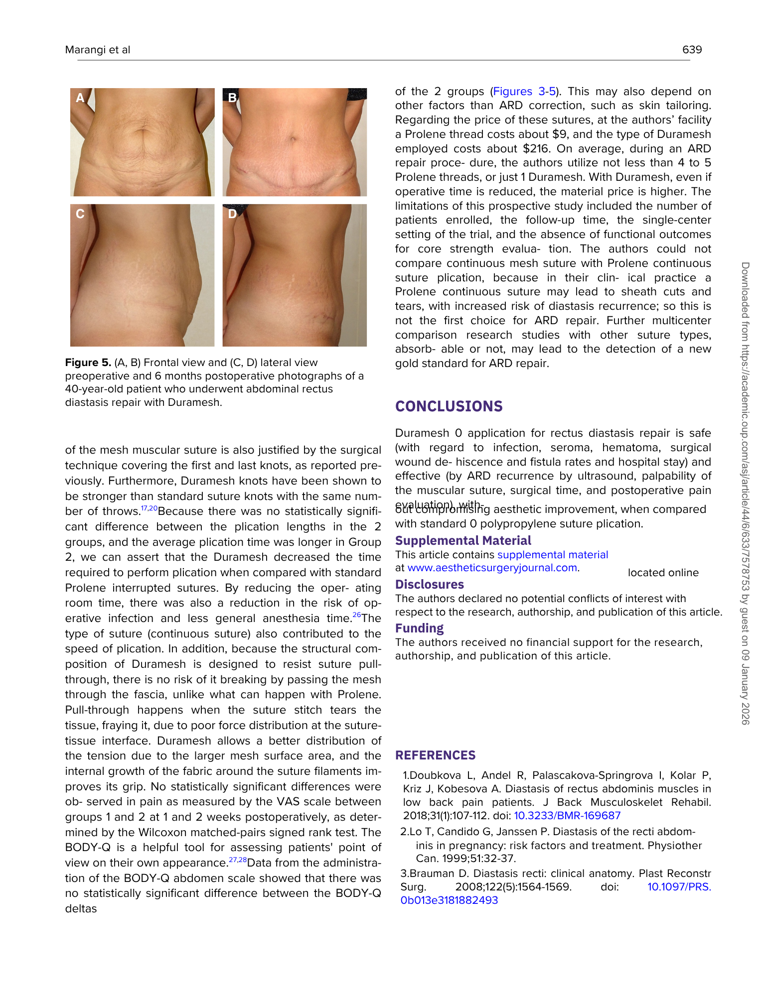 Immagini che mostrano i decorso preoperatorio e postoperatorio di un intervento chirurgico di riparazione della diastasi del retto addominale su un paziente di 40 anni, con vista frontale e laterale.