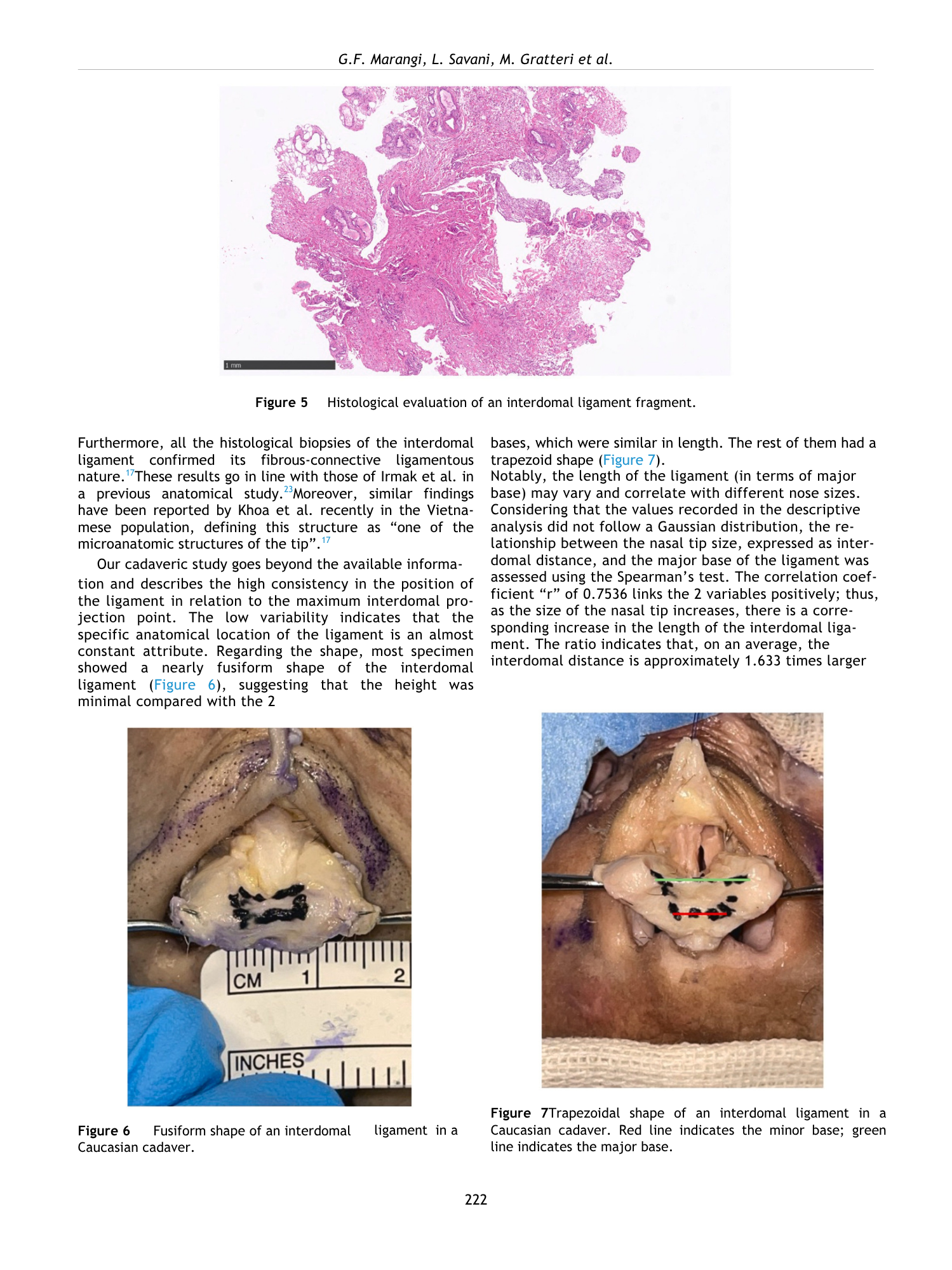 Immagine di un campione anatomico di un legamento interdotale di un cadavere caucasico, con linee colorate che indicano le basi maggiore e minore.