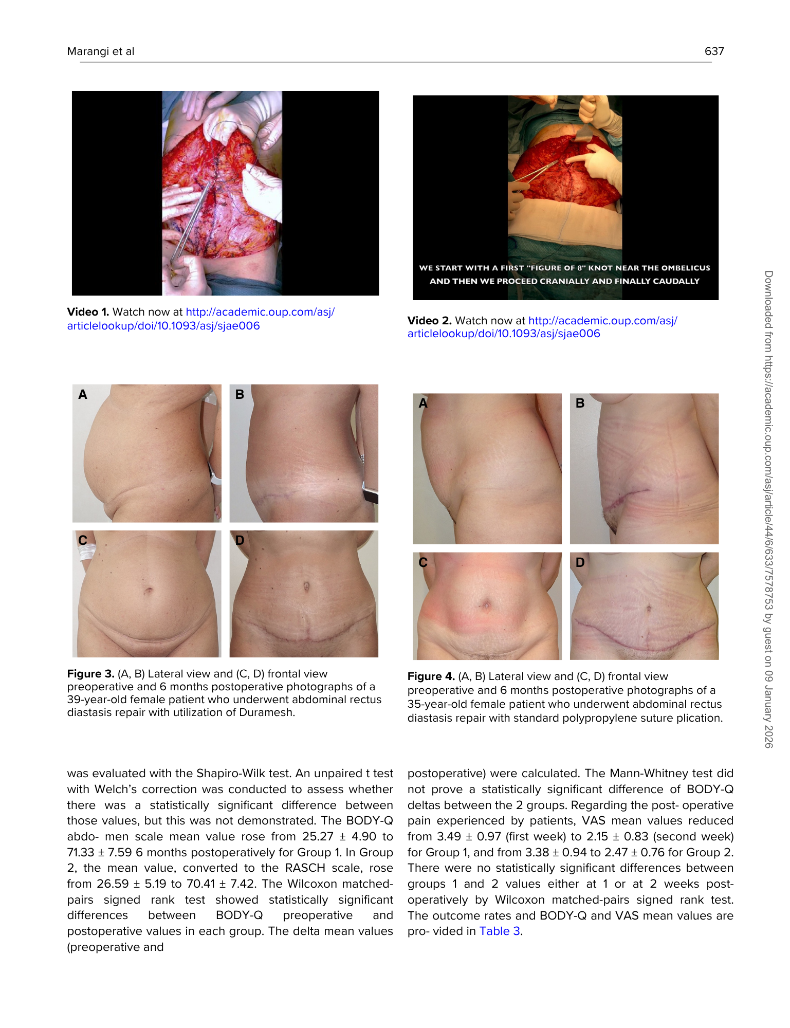 Immagine di due video che mostrano procedure chirurgiche di riparazione della diastasi dei retti addominali, con didascalie che indicano i link ai video. Sotto, fotografie frontali e laterali di due donne, una prima dell'intervento e una dopo, con in