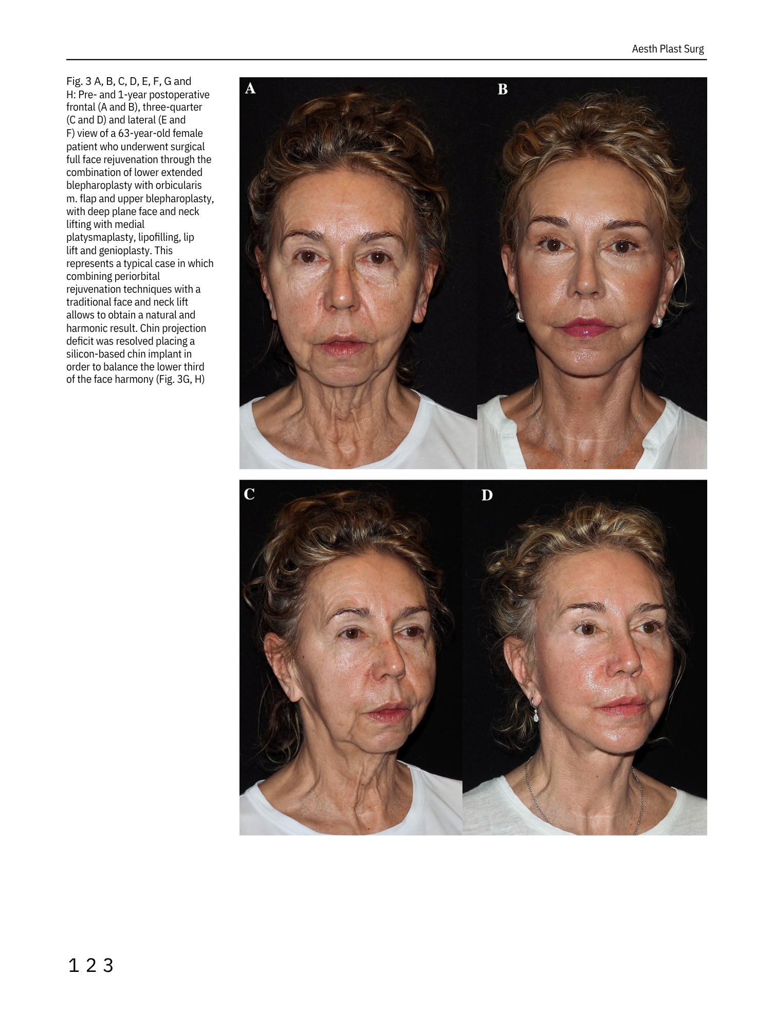 Immagini di una donna di circa 63 anni prima e dopo interventi di chirurgia facciale. La prima immagine (A) mostra il viso dell'anziana prima dell'intervento, mentre la seconda (B) mostra il risultato dopo il lifting e altri interventi. Le immagini C