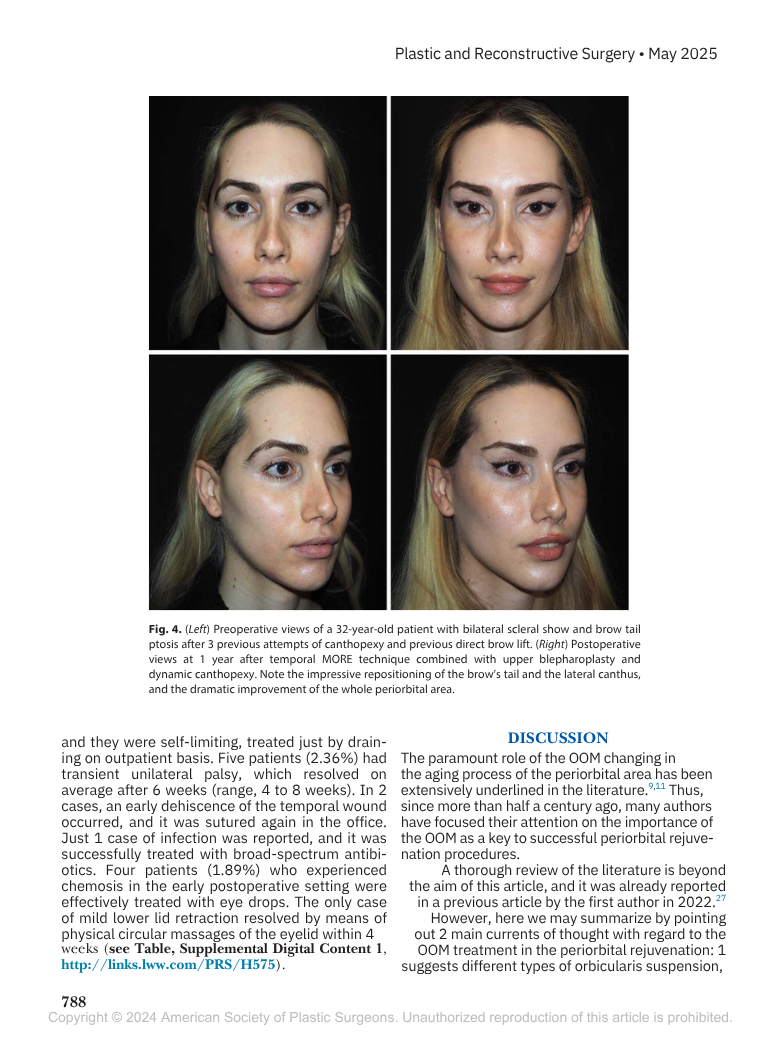 Immagini pre e post-operatorie di un paziente di 32 anni con ptosi bilaterale della sclera e coda dell'arcata sopraccigliare, mostrate in quattro viste diverse, dopo trattamenti chirurgici di cantopessi e dell'arcata sopraccigliare.