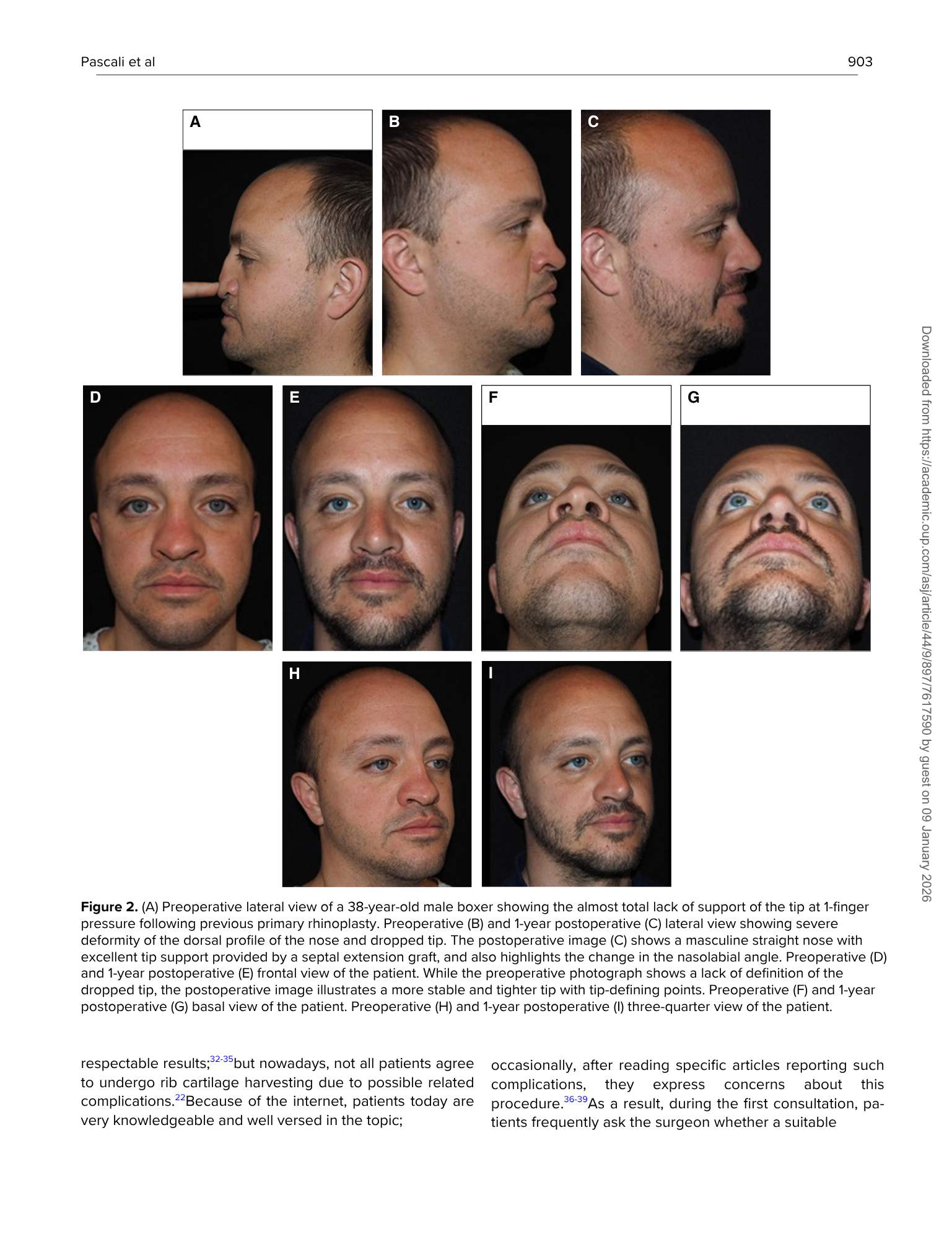 Immagini di un uomo di 38 anni in diverse prospettive before e after un intervento di rinoplastica, mostrando il profilo del naso e il ponte, con dettagli sul supporto del lampo e la forma del naso.