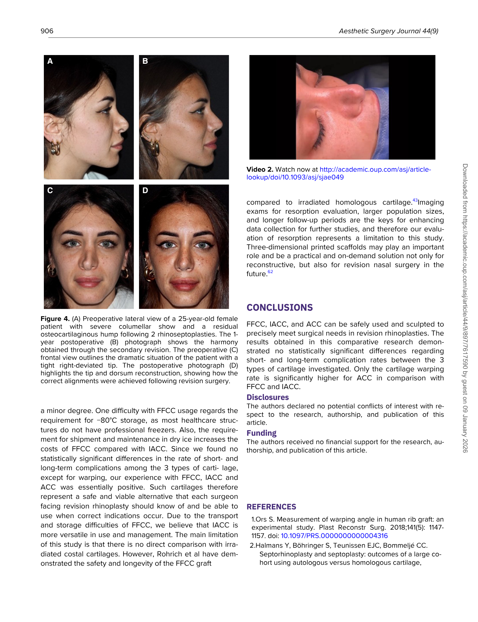 Immagini di una paziente femminile di 25 anni con profilo laterale e fronte, prima e dopo intervento di rinoplastica, e una foto ravvicinata del naso dopo l'intervento.