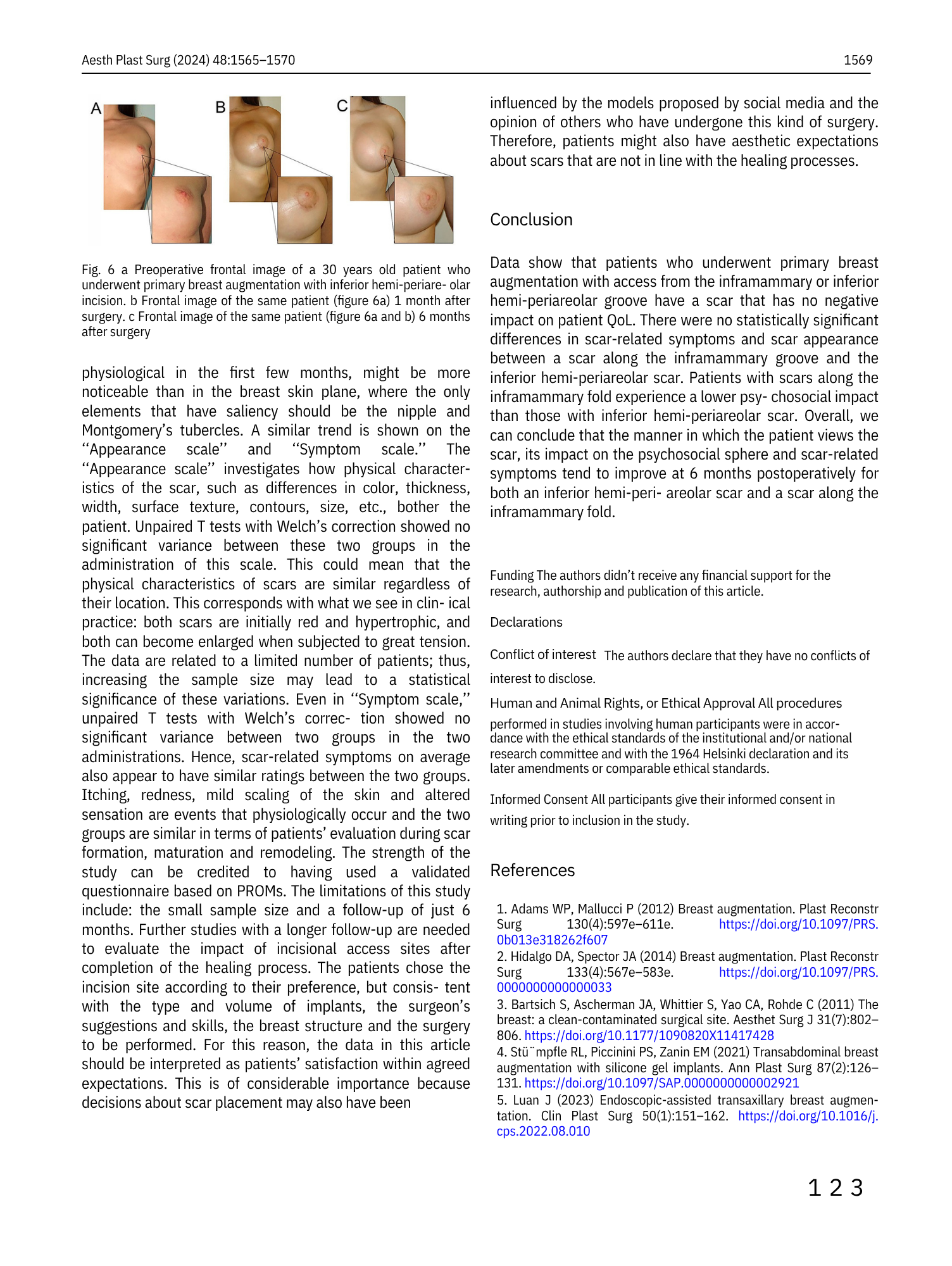 Immagini preoperatorie e postoperatorie di un paziente di 30 anni sottoposto a aumento mammario con innesto inferiore. Tre immagini: a) preoperatoria, b) uno mese dopo l'intervento, c) sei mesi dopo l'intervento.