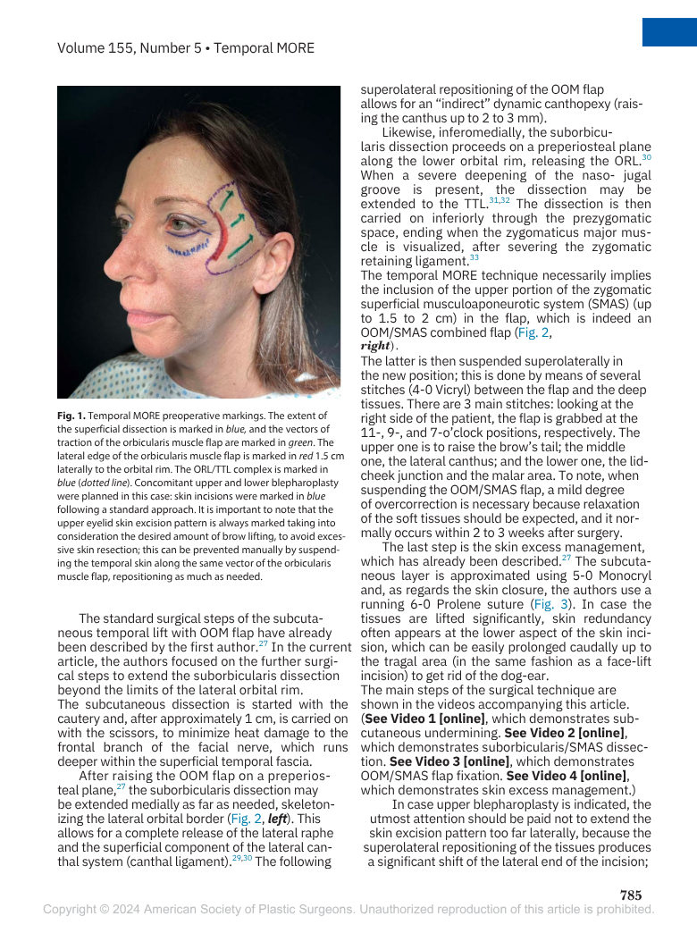 Immagine di una donna che mostra markings preoperatori temporali blu e verdi sul volto, con incisioni e linee guida per una procedura chirurgica facciale.