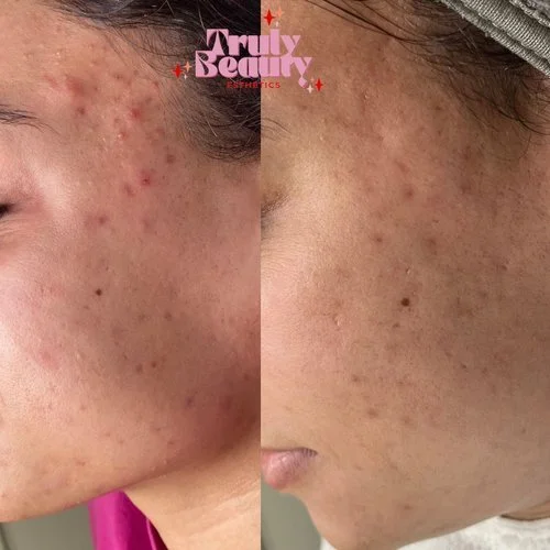 Comparison of skin before and after treatment showing reduction in acne scars and dark spots.