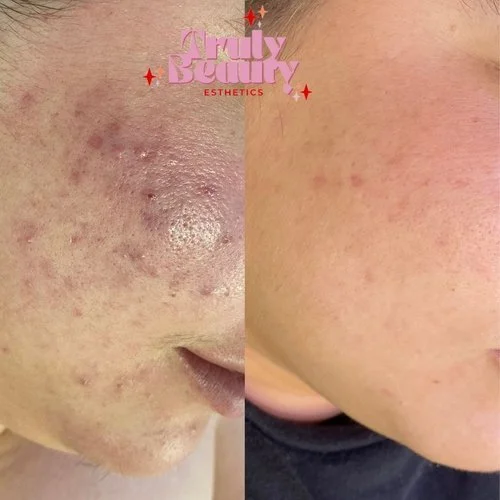 Side-by-side comparison of a person's cheek showing severe acne and scars on the left, and clear, smooth skin on the right.