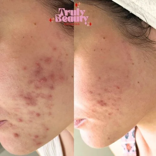Close-up of a person's cheek showing clear skin with acne scars and redness, before and after skin treatment