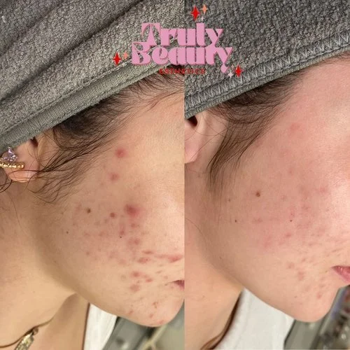 Close-up comparison of a person's cheek showing acne before and after skin treatment, with the text 'Truly Beauty' at the top.